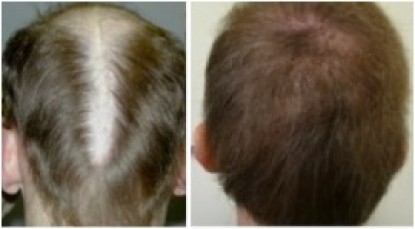 Hair transplant repair of slot formation
