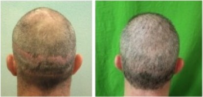 Hair transplant repair of two strip scars.