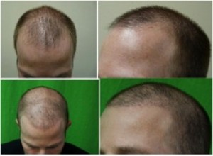 Sample Patient A: real patient of DermHair Clinic