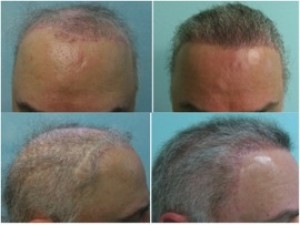 best hair transplant Best hair transplant : real patient of DermHair Clinic