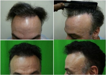 Beard Hair Transplant| temple hair recession