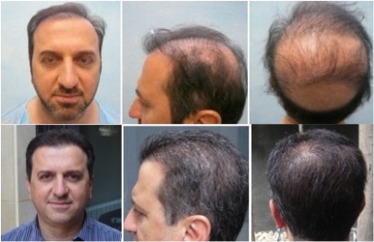 a beard hair transplant was used to correct the mistakes of a past strip surgery