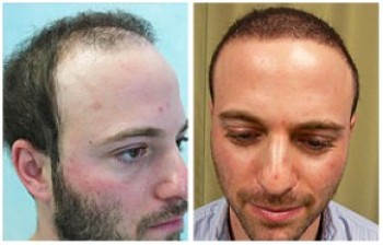 Head & Beard Hair| body hair transplant results| Growth and strip scar coverage