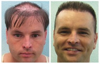Impossible hair repair|patient case|botched results|Body hair transplant results|patient success