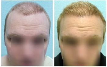 Body hair transplant can create very natural looking results