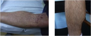 Lower leg donor area immediately post-surgery and after healing.