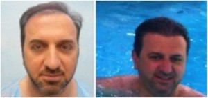 Dr U Hair Transplant Results : Patient able to swim post-procedure without the worry of a hairpiece or concealing powder.