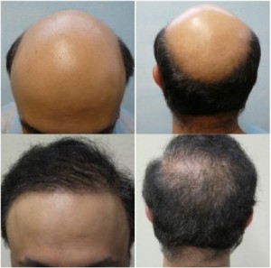 Hair transplant results on severely bald patient