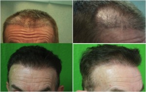 Hair transplant results of repair patient