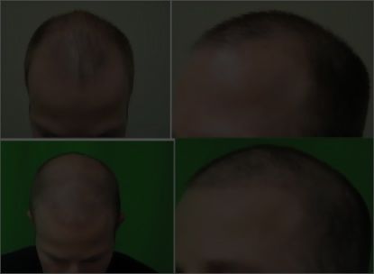 Hair Transplant Videos Are less deceptive - Do not trust photographs that appear altered, too dark, or too light.