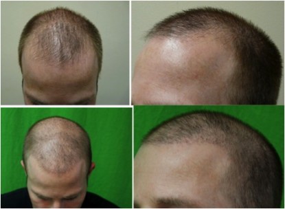 Trustworthy hair transplant photo of patient before and after procedure.