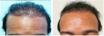 African American FUE Hair Transplant, BHT successful results by Dr U