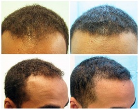 African American FUE Hair Transplant 