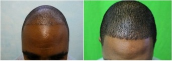 African American FUE Hair Transplant, before and after result of a Dr U patient