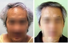 Asian FUE Hair Transplant result by Dr U using UGraft