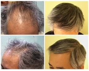 Asian FUE Hair Transplant, Natural looking results