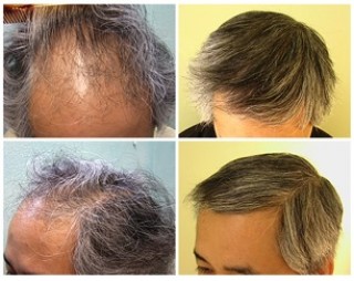 Ethnic Hair Loss| Asian Hair Restoration|FUE transplant|hairline, temples & frontal scalp