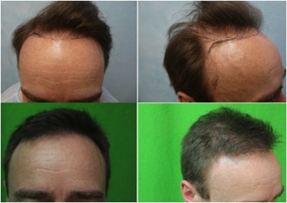FUE hair transplant repair results|body hair grafts|patient photos
