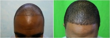 FUE Hair Transplant |black patient|before & after