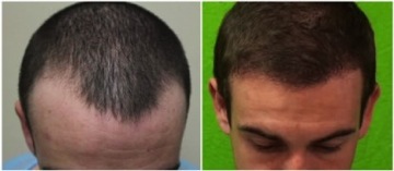 FUE hairline transplant results|depleted temples|patient photos -before&after