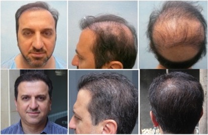 best FUE hair transplant results|repairing botched surgery|body hair transplant