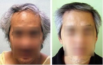 FUE Transplant| Asian Patients|Ethnic Hair Loss