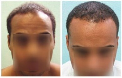 Ethnic Hair Loss | African American male|FUE hairline restoration