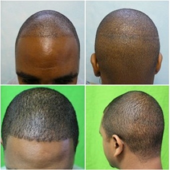 Ethnic Hair Loss | FUE hairline restoration|strip scar repair|African American