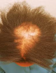 female hair loss|black women|harsh chemicals