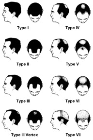 Norwood scale for MPB shows typical thinning at the hairline, temple points, and vertex.