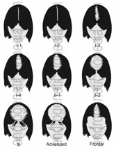 Savin scale for FPB shows typical diffuse thinning across the top of the scalp.