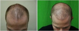 Receding hairline advanced with low level of FUE grafts using uGraft.