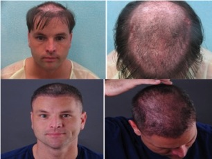 FUE repair for hair replacement surgery|Body hair grafts