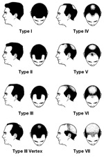 genetic pattern hair loss in males|Androgenic Alopecia
