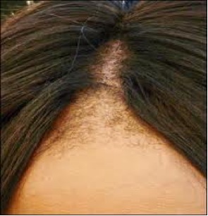 Traction Alopecia |front|hairline