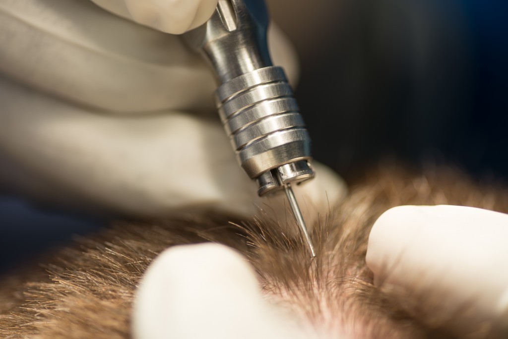 UPunch Rotor used by Dr U in a hand held and directed manner to remove chosen grafts UPunch Rotor used by Dr U in a hand held and directed manner to remove chosen grafts