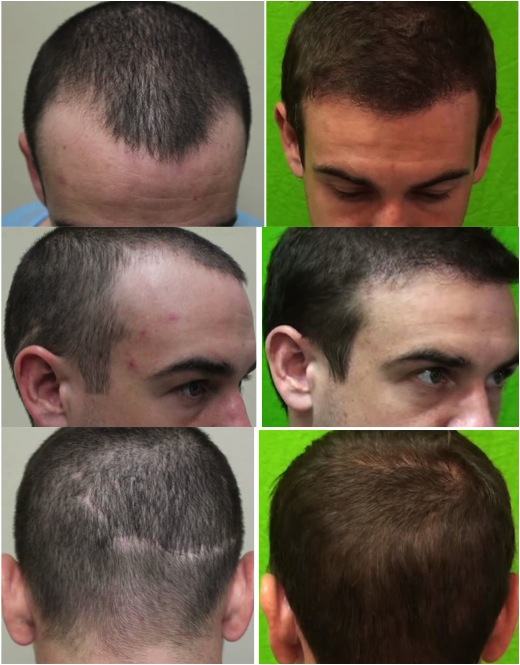 patient before and after his FUE hair restoration for the hairline and strip scar | best FUE hair transplant surgeon