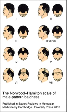 Hair Loss Info|male pattern baldness stages|Hamilton Norwood