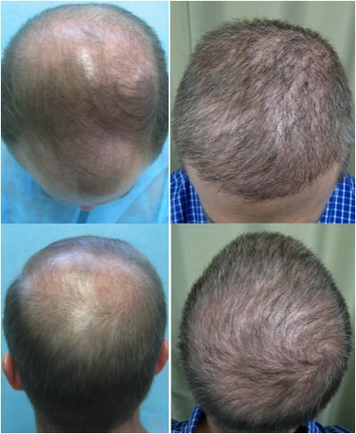 Treatment for Severe Baldness | Norwood 6|Body Hair Transplant Results