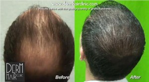 FUE-hair-restoration-080-300x165.jpg