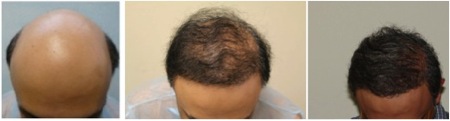 Best Hair Restoration Clinic in the World |severe baldness - Norwood 7