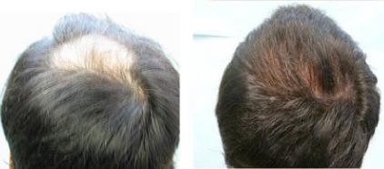 Crown Hair Restoration |
