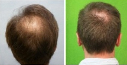 Crown Hair Restoration |improving density