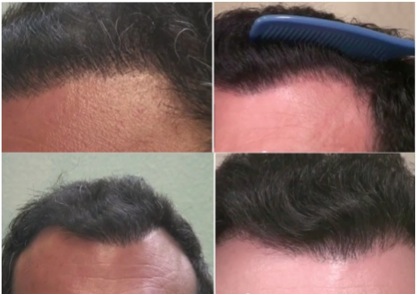 Hairline Restoration| Natural Looking Results