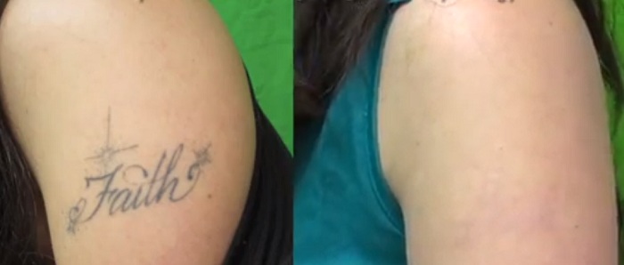 Before and after pictures of Los Angeles tattoo removal
