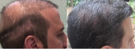 Hair Transplant Clinic in Los Angeles, CA