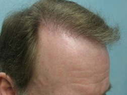 before Temple Hair Restoration and repair by the UGraft FUE