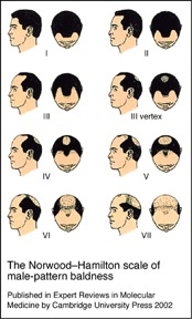 Temple Hair Transplant|Norwood Scale - hair loss stages