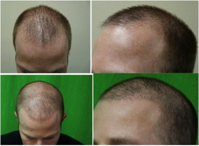 Temple Hair Transplant | restoring temple points