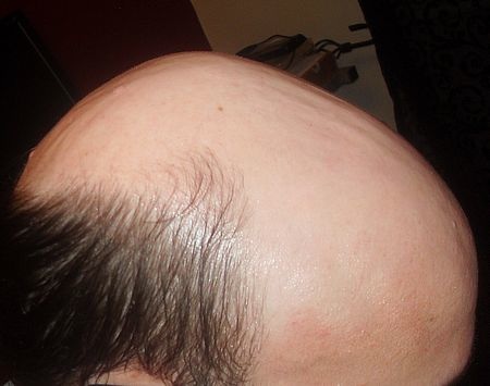http://www.dermhairclinic.com/wp-content/uploads/2013/02/beard-hair-transplant-2.jpg